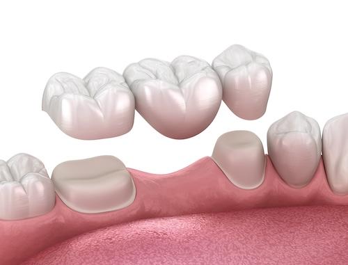 close up of dental bridge in lower jaw | dental bridges allentown pa