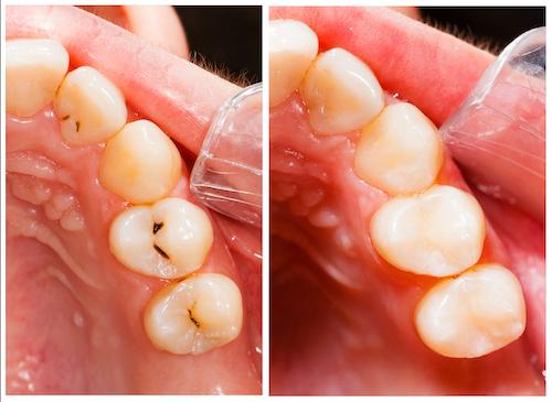 close up of cavities | cosmetic dentistry allentown pa