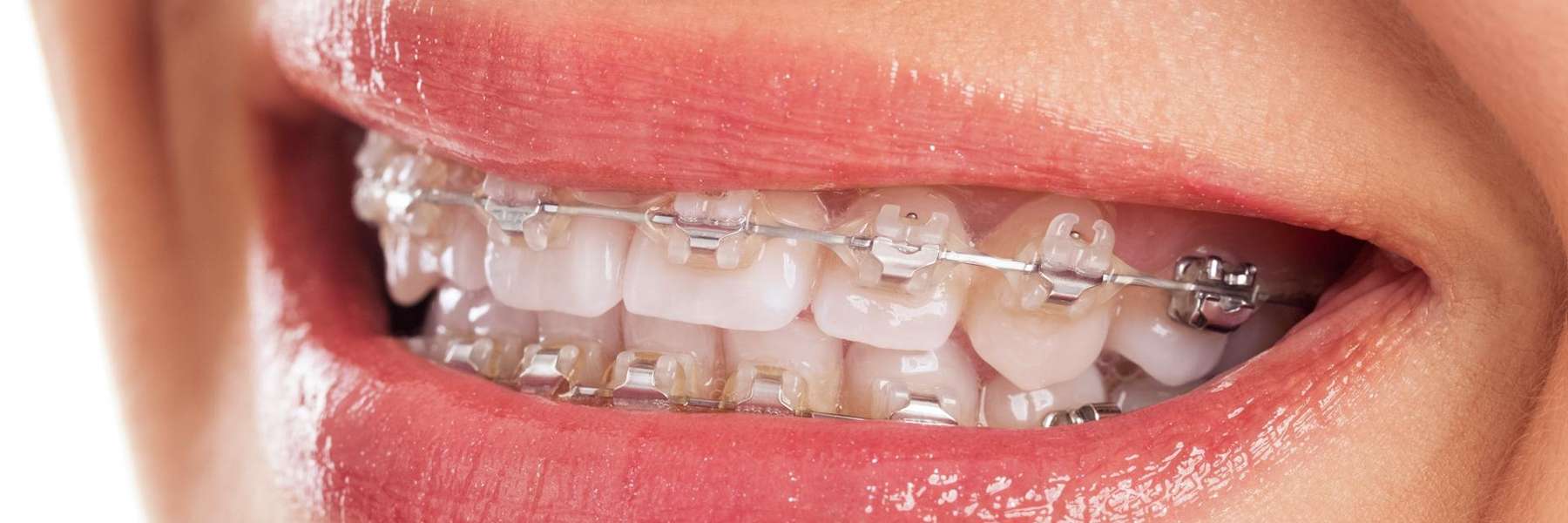 A smiling woman with braces