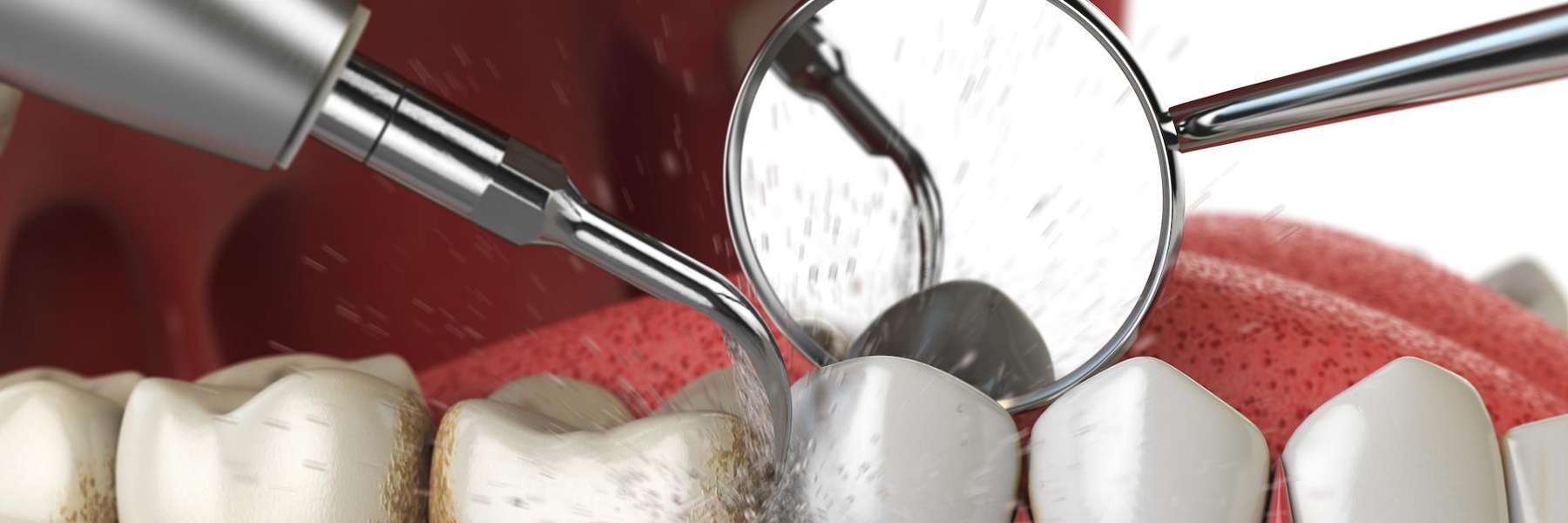dental cleaning in Allentown