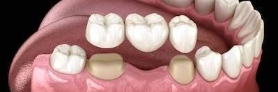close up of dental bridge l dental bridges allentown pa