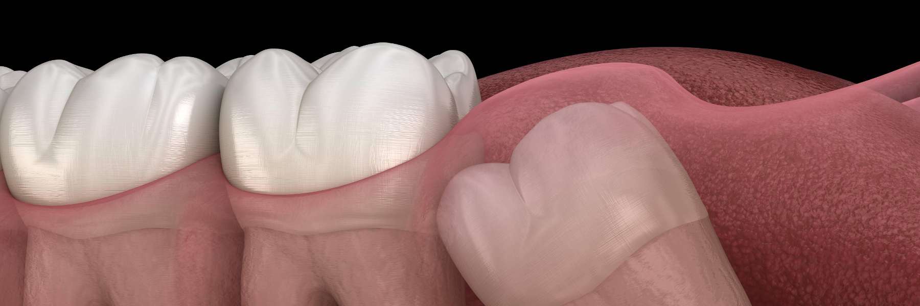An illustration of a wisdom tooth growing improperly