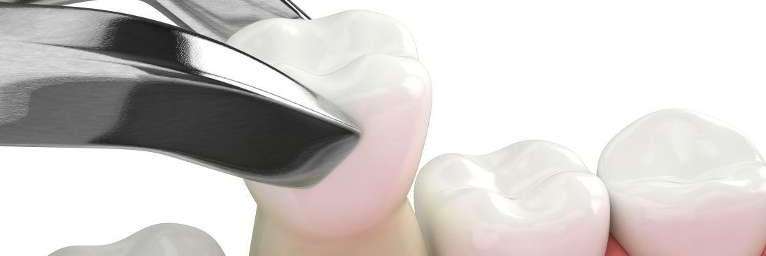 An illustration of a tooth being extracted | dentist Allentown