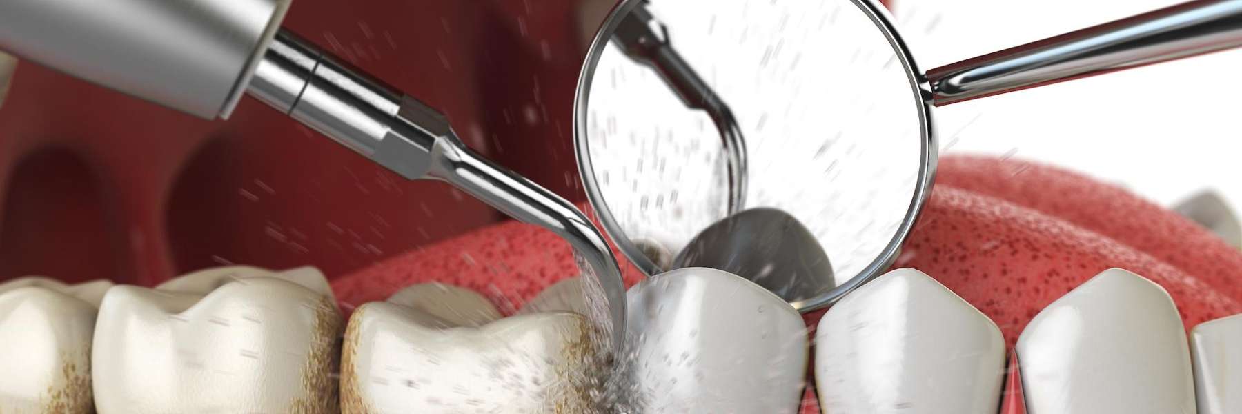 An illustration of a teeth cleaning | allentown pa dentist