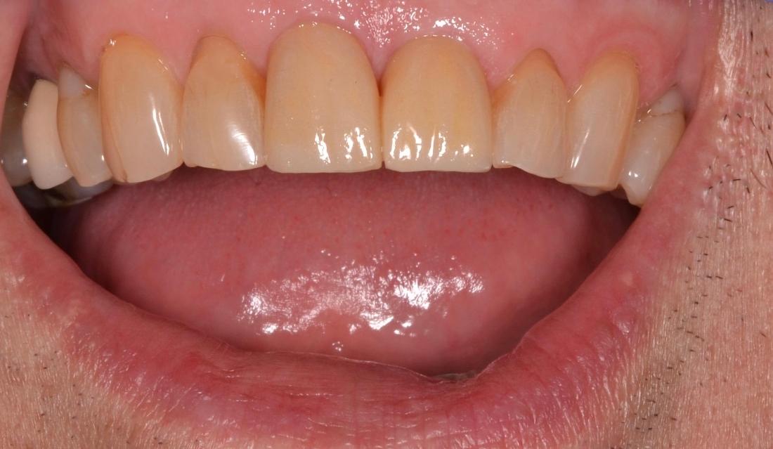 complete smile after dental treatment | cosmetic dentist allentown pa