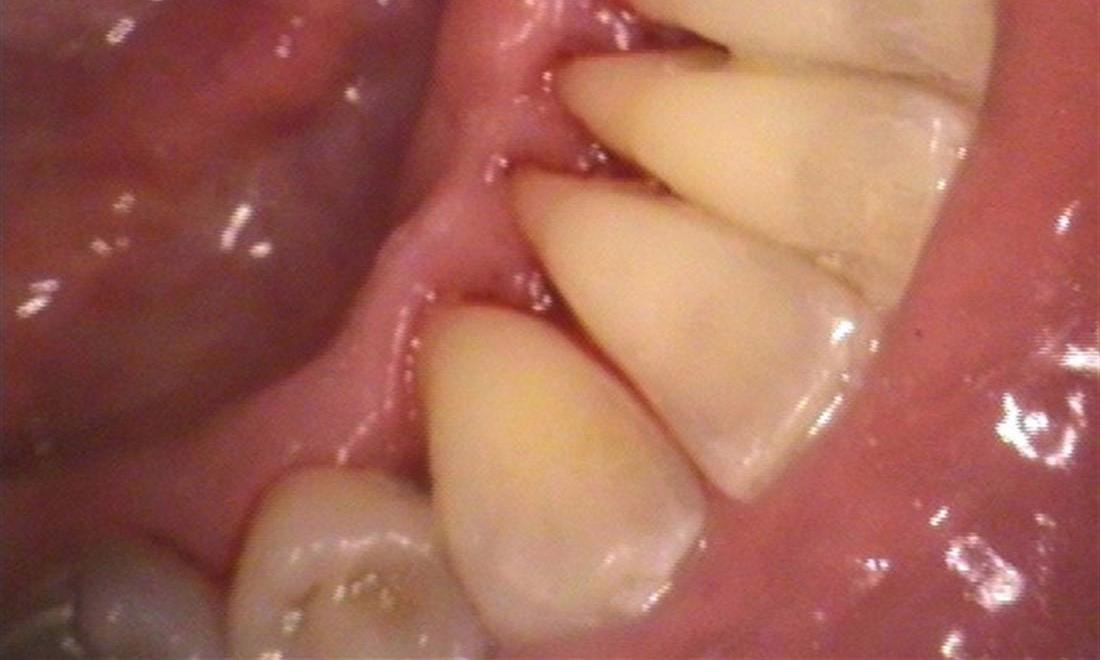 clean teeth after dental cleaning l allentown dentist
