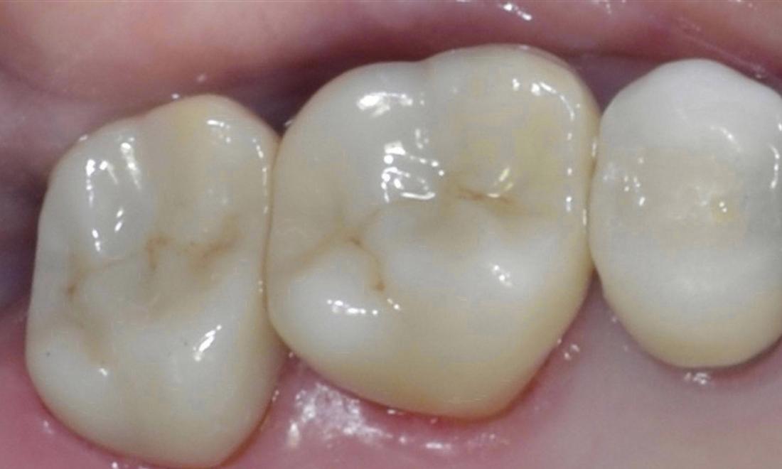 Patient with ceramic crowns | allentown dentist