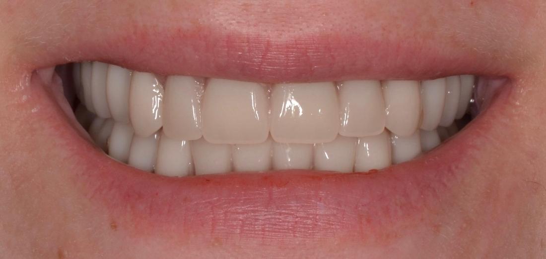 Full Dentures Results | Dentures Allentown PA