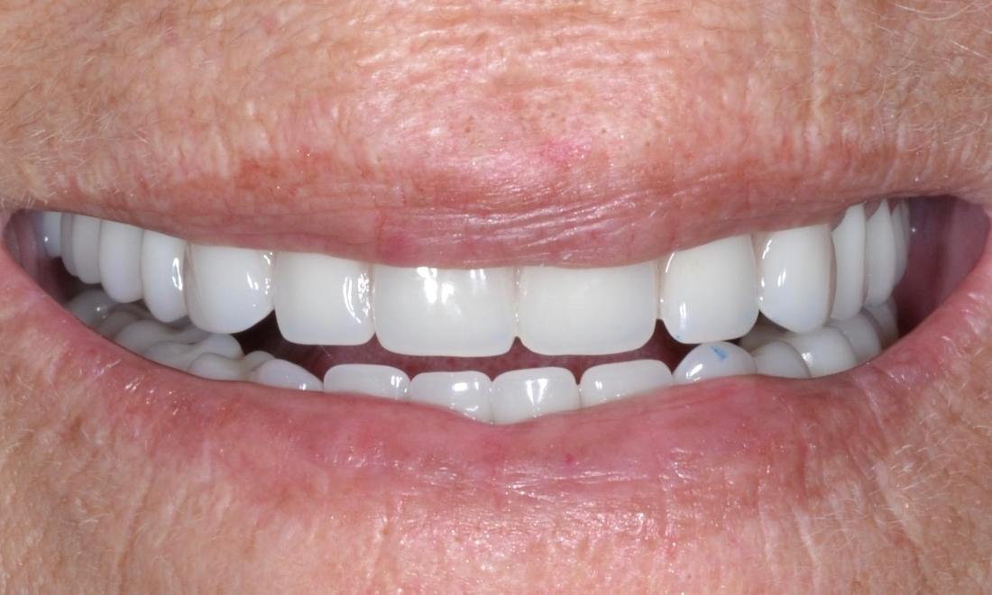 Patient with new implant supported denture | Allentown PA