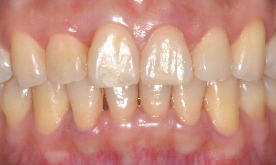 Invisalign Results | 18103 Dentist