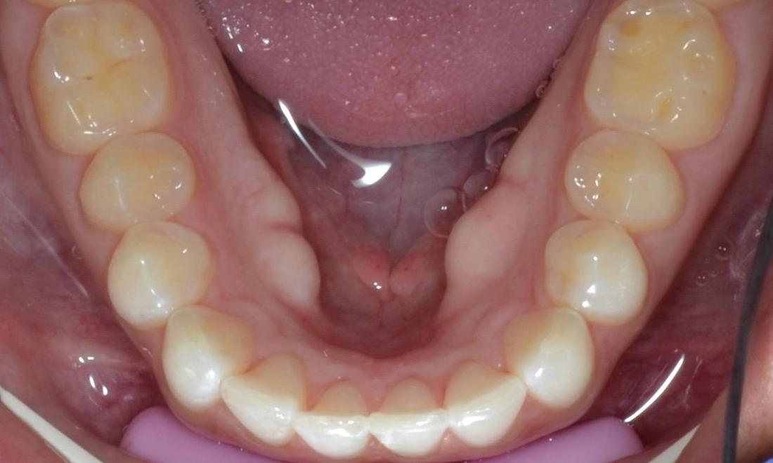 straight smile after Invisalign l dentist allentown pa