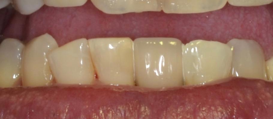 complete smile after dental bridge | allentown dentist