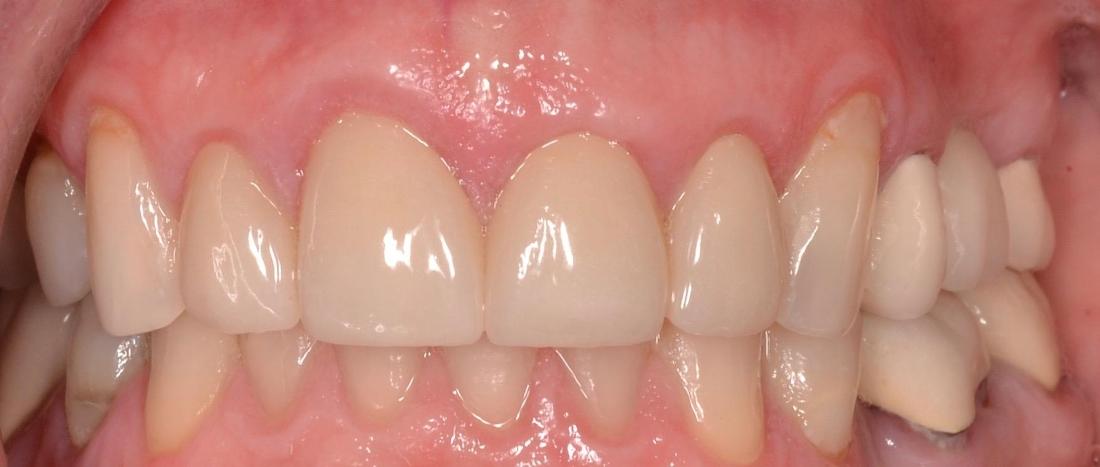 bright smile after smile makeover l dental crowns allentown