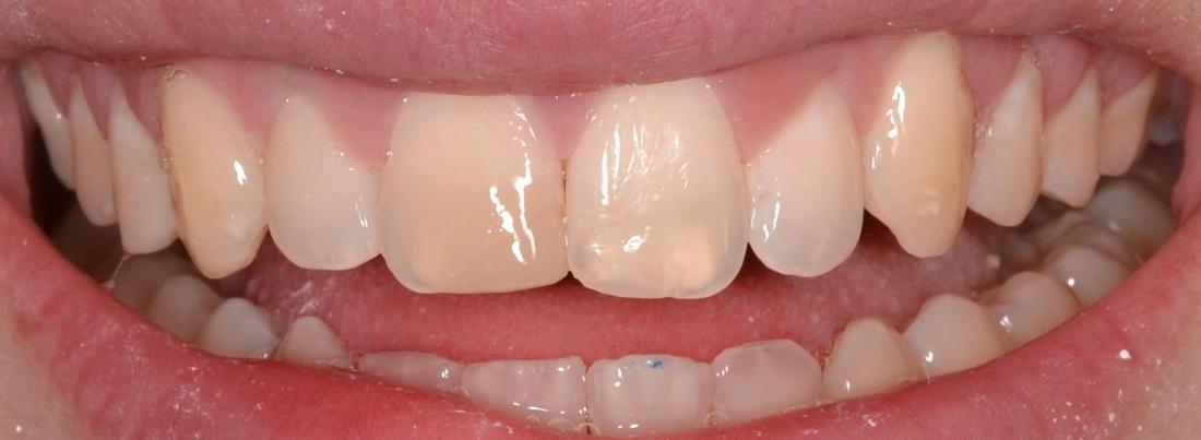 after tooth colored filling | tooth colored filling allentown pa