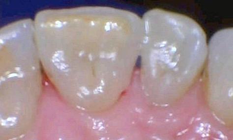 White Fillings | Emmaus PA