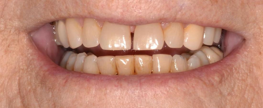 full smile after dental treatment | dental implants allentown pa