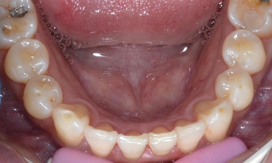 Invisalign Results | Dentist Allentown PA