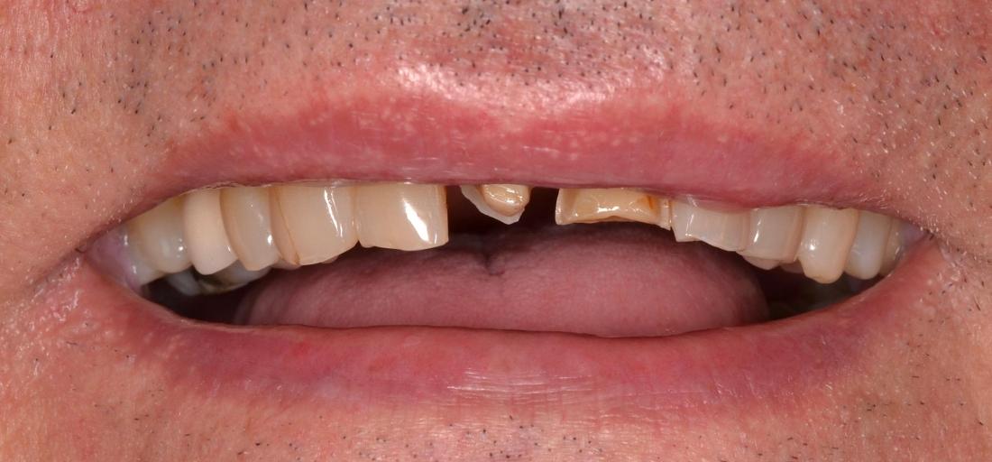broken teeth before dental crowns | allentown dentist