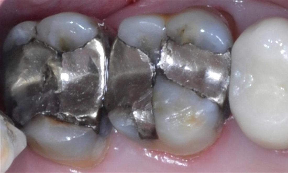 Patient before ceramic crowns | dentist allentown pa