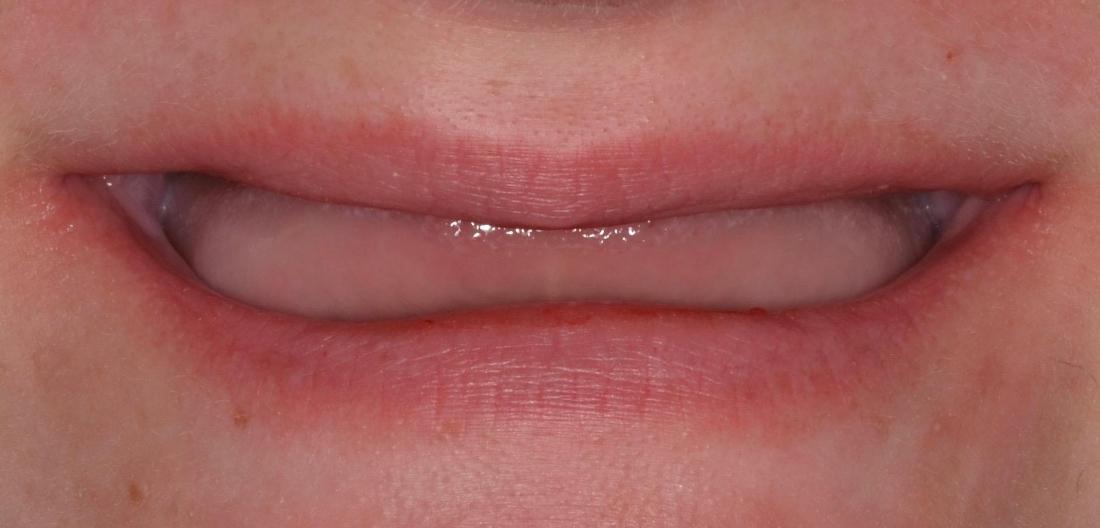 Patient Before Full Dentures | Allentown Dentist