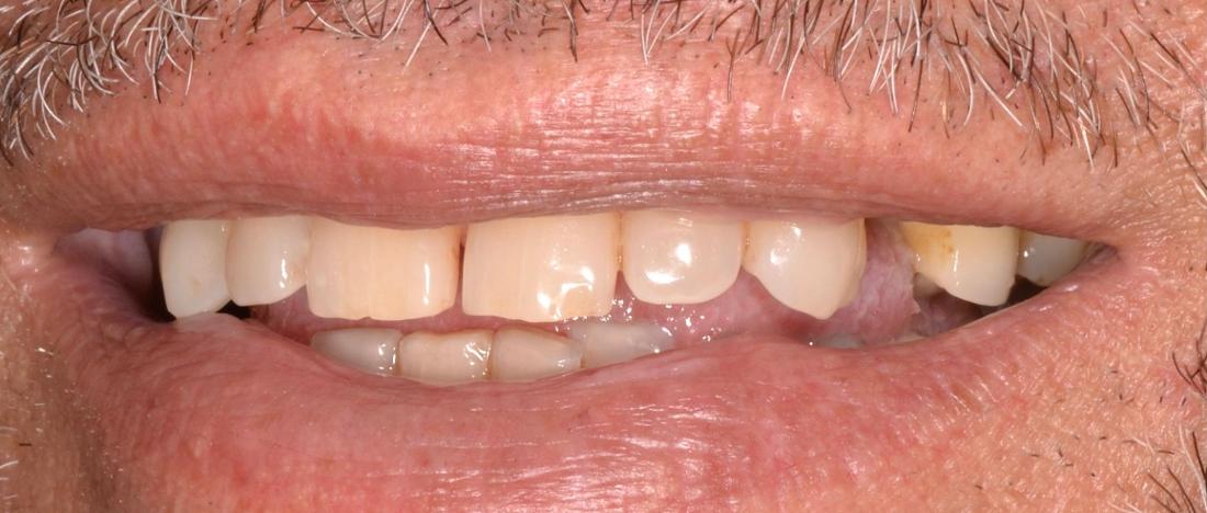 fractured tooth before dental treatment | allentown dentist