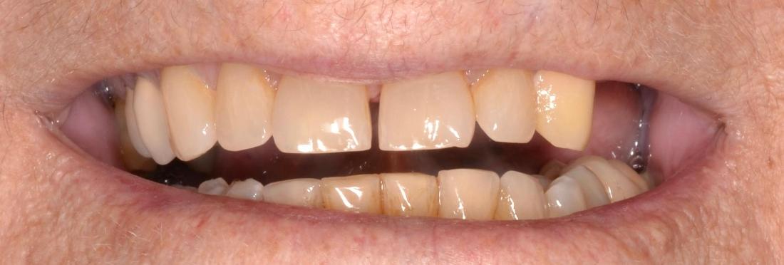 missing teeth before dental implants | allentown dentist