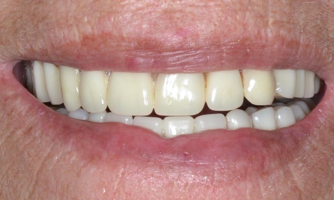 Patient in need of new denture | Allentown PA Dentures