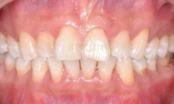 Patient Before Invisalign | Dentist Allentown PA