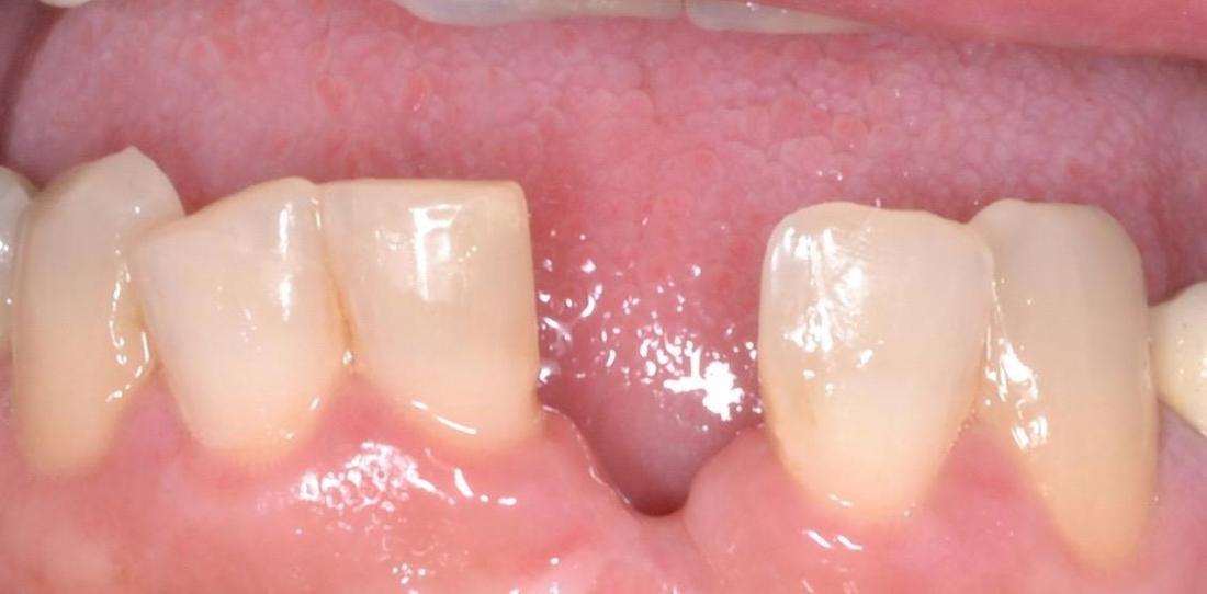 close up of missing front tooth | dental implant allentown pa