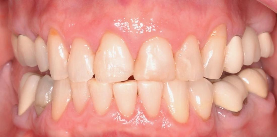 dingy teeth before smile makeover l allentown dentist