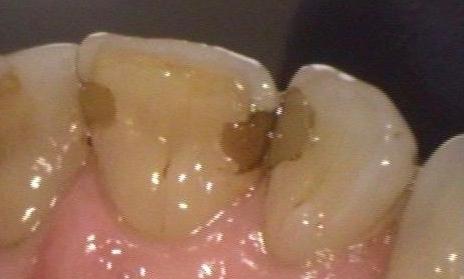 Patient Before White Filling | Emmaus PA