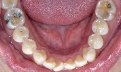 Patient Before Invisalign | Allentown Dentist