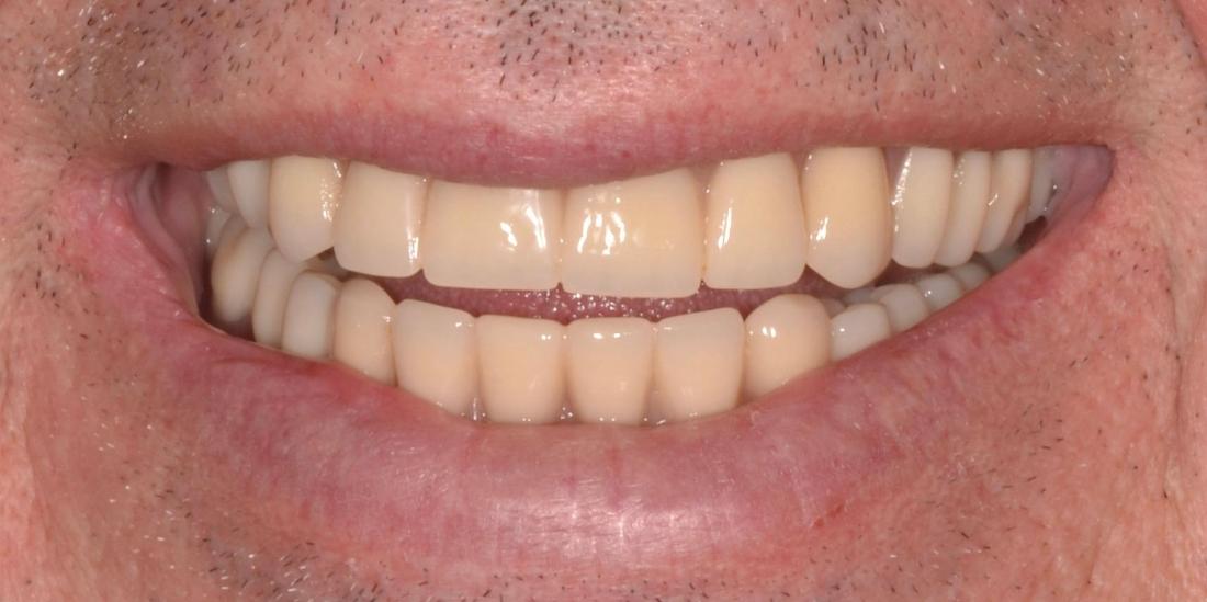 beautiful smile after dental treatment | dentures allentown pa