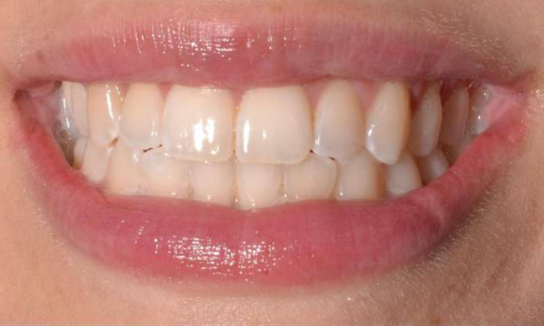 bright smile after dental treatment | teeth whitening allentown pa