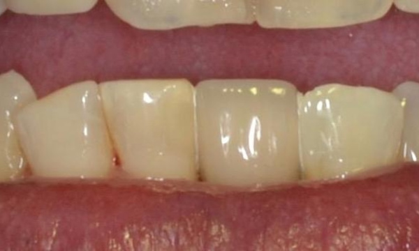 complete smile after dental bridge | allentown dentist