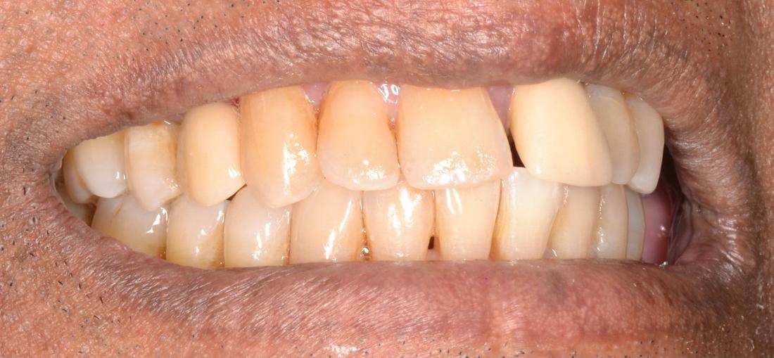 corrected smile after cosmetic dentistry | dentist allentown pa