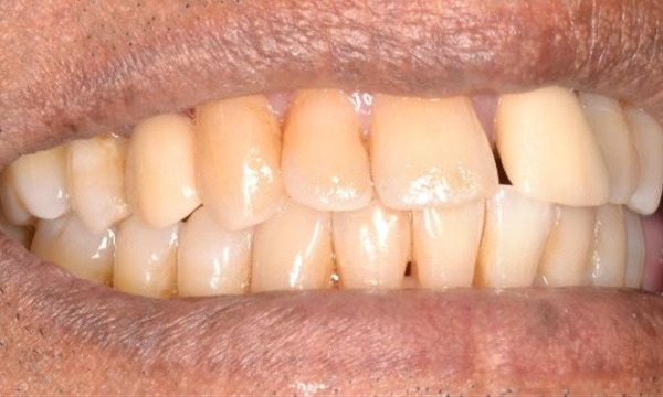 looking smile after single-tooth dental implant restoration in Allentown, PA