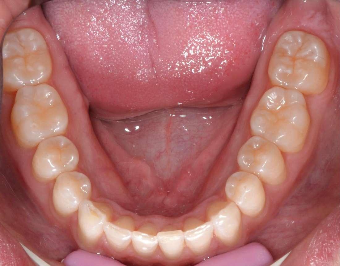 straight smile after Invisalign | dentist allentown pa