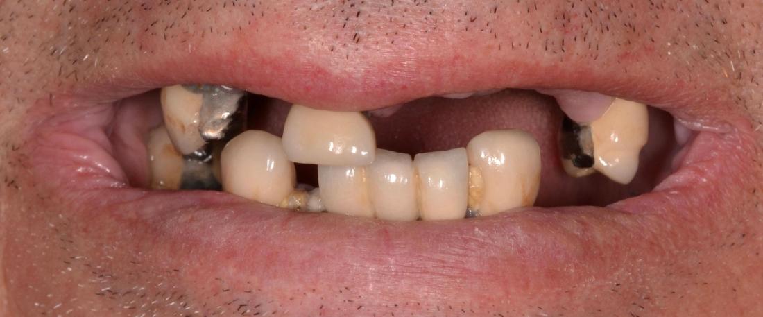 missing teeth before dentures | allentown dentist