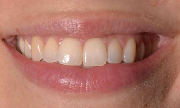 dingy teeth before teeth whitening | cosmetic dentist allentown pa
