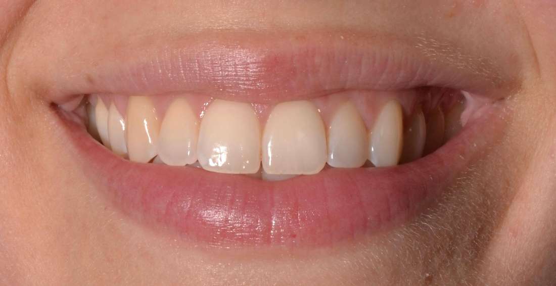 dingy teeth before teeth whitening | cosmetic dentist allentown pa