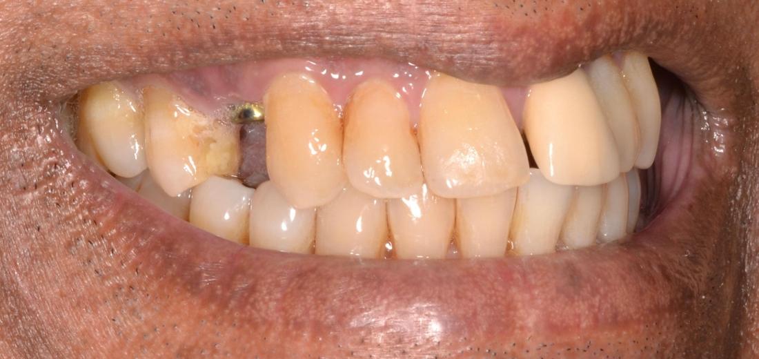 missing teeth before dental implants | dental implants allentown pa