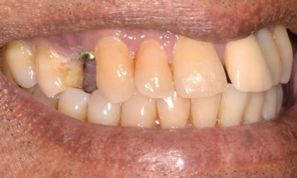 Fractured tooth before dental implant treatment in Allentown, PA
