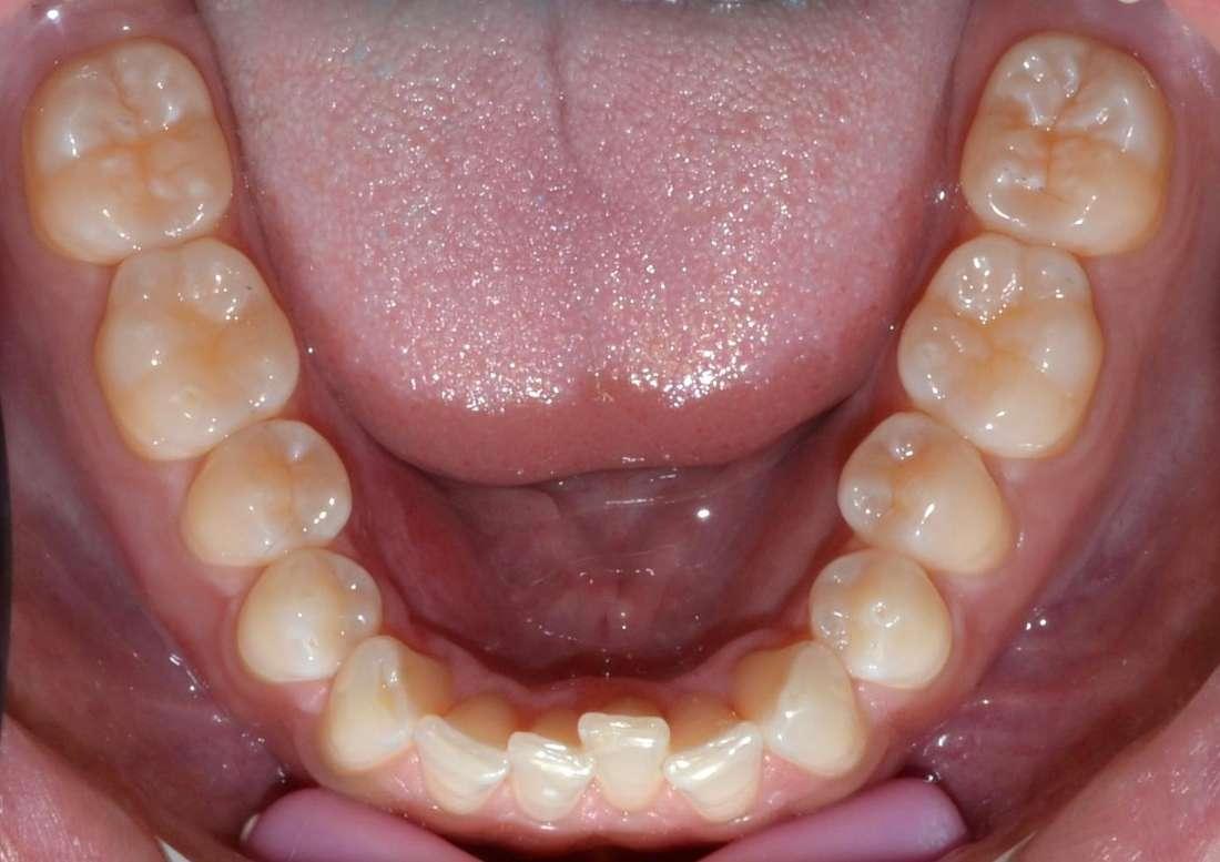 misaligned teeth before dental treatment l invisalign allentown pa