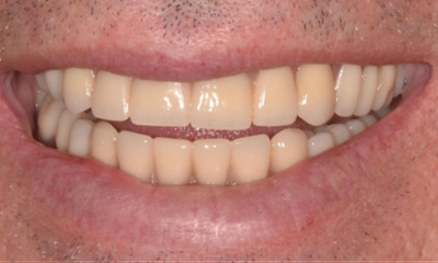 beautiful smile after dental treatment | dentures allentown pa