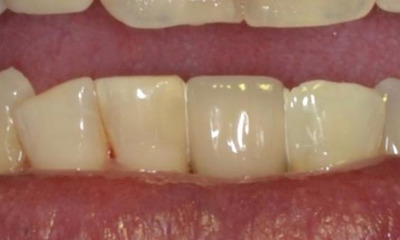 complete smile after dental bridge | allentown dentist