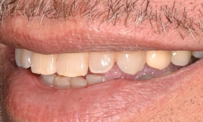 restores teeth after dental implant | dental implants allentown pa