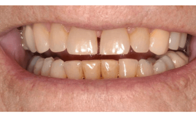 full smile after dental treatment | dental implants allentown pa