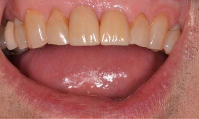 complete smile after dental treatment | cosmetic dentist allentown pa