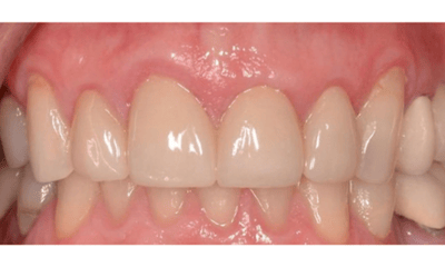 bright smile after smile makeover l dental crowns allentown